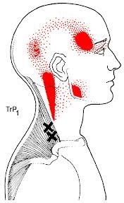 Typical referred neck pain pattern